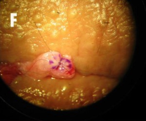 vasovasostomie operatie F